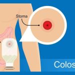 Ostomías, generalidades y cuidados.